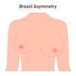 Asymmetric female breast. Different sizes of right and left boob