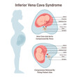Inferior vena cava syndrome. Pregnant woman has a compression