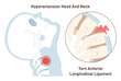 Neck hyperextension. Anterior longitudinal ligament torn. Spinal cord