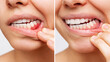 © Марина Демешко - Two shots of a young woman with red bleeding gums and health gums, before and after treatment on a white background. Result of curing of gum inflammation. Close up. Dentistry, dental care. Comparison