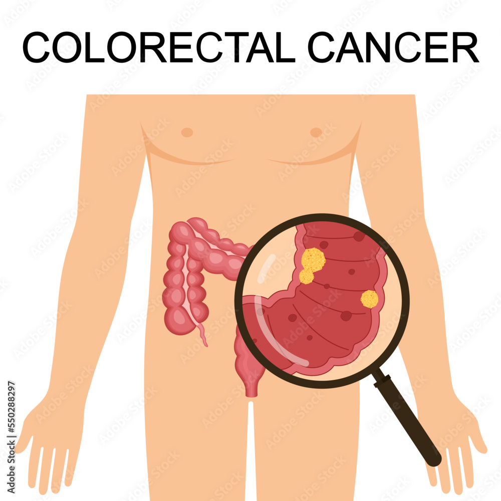 Colorectal canser CRC vector illustration. Colon canser. Medical ...