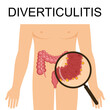 Diverticulitis and diverticulosis vector illustration. Medical structure and location. Diverticula infected or inflamed. Intestines. Bowel colon cancer, crohn's disease polyp hernia rectum
