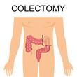 Colectomy vector illustration. Medical structure and location. Intestines. 