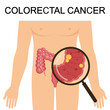 Colorectal canser CRC vector illustration. Colon canser. Medical structure and location. Intestines. Bowel colon cancer, crohn's disease polyp hernia rectum