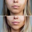 © Марина Демешко - Chin reduction with fillers. Woman's face with jaws and chin before and after mentoplasty on a gray background. The result of cosmetic plastic surgery. Beauty concept