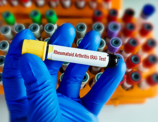 Canvas Print - Blood sample RF (Rheumatoid factor) or RA (Rheumatoid arthritis) test, diagnosis for rheumatoid arthritis disease.