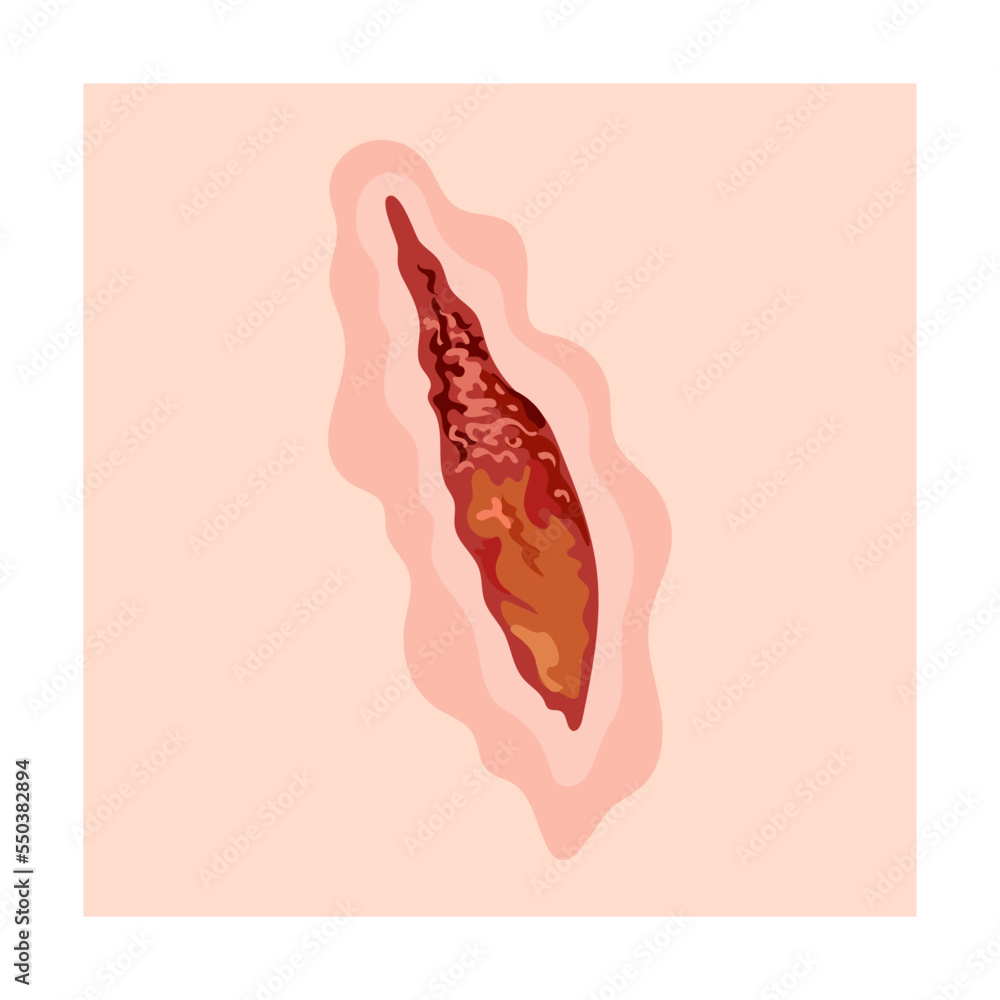 Skin scar cartoon illustration. Bloody wound, injures, scratches ...