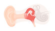 耳の構造のイラスト_急性中耳炎_炎症した鼓膜と中耳