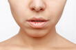 Cropped shot of a young caucasian woman with dry cracked lips from frost or vitamin deficiency isolated on a white background. Flaky, weathered lips