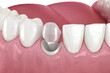© Alex Mit - Dental stump pin tab on canaine tooth. Medically accurate dental 3D illustration