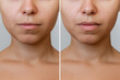 © Марина Демешко - Result of lip augmentation. Cropped shot of young woman's lower part of face with lips before and after lip enhancement on a gray background. Injection of filler in lips
