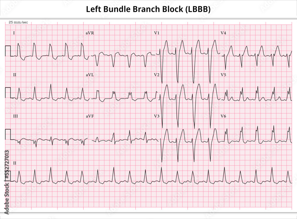 ECG Left Bundle Branch Block - ECG Paper 12 Lead