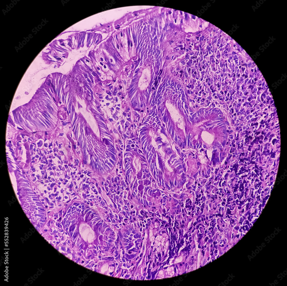 Light micrograph of wall of the small intestine (duodenum) showing villi and Brunner's gland hyperplasia, duodenal mucosa.