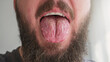 Geographic tongue disease (Candidiasis). Tongue Inflammatory lesions and cracks.