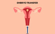 © Heena_Rajput - Embryo transfer with Embryon and uterus, Embryo transfer by syringe In vitro fertilization. Vector illustration.