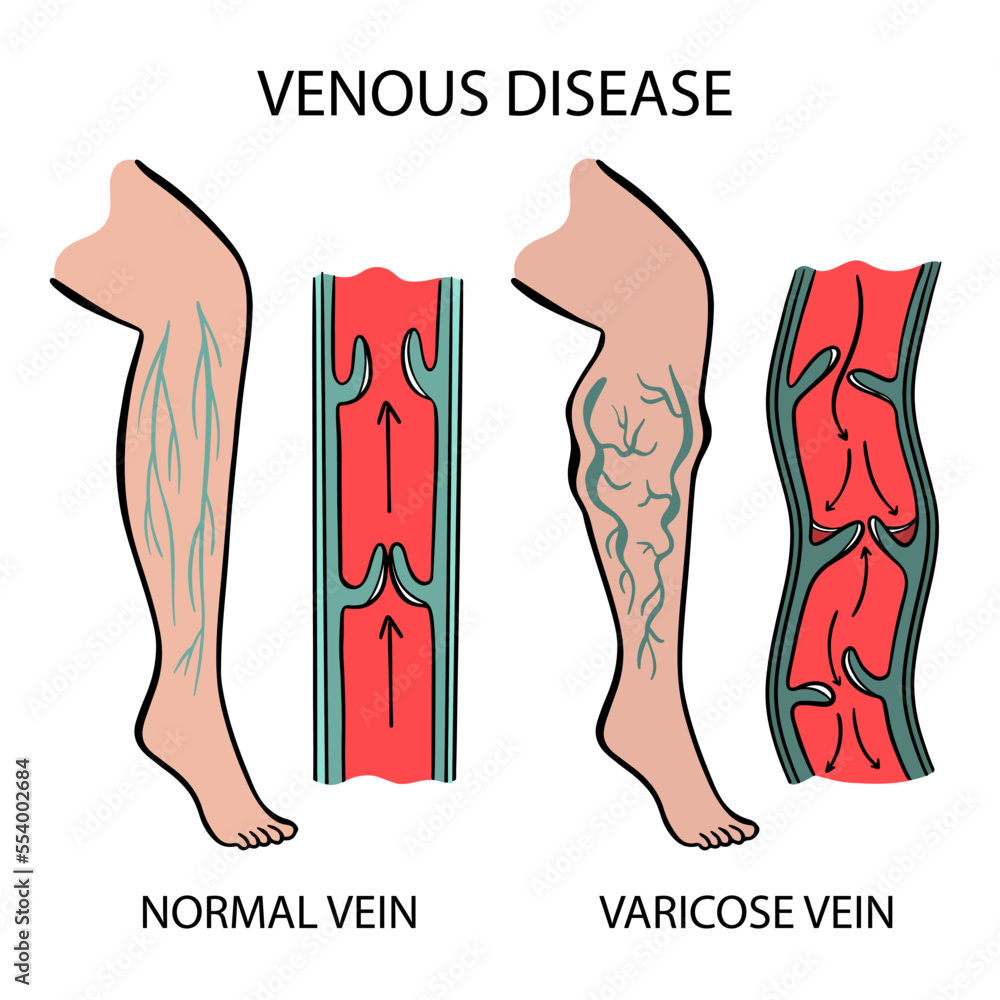 VENOUS DISEASE Varicose Veins Of Human Legs Twisting And Dilation Of Blood Vessels Schematic Representation Of Changes In Body Parts For Medical Education