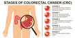 Stages of colorectal cancer CRC. Colon cancer. Colorectal oncology tumor.  Bowel cancer.