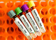 Leinwandbild Motiv Close view of blood samples for sexually transmitted infection (STI) test, STD. HIV, SYPHILIS, HEPATITIS C, HEPATITIS B.