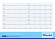 Sinus bradycardia refers to the frequency of impulses issued by the sinus node less than 60 beats per minute, and the ECG shows a slow sinus rhythm. 