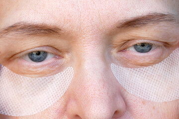 middle aged female's eye with drooping eyelid with patch for eyes. ptosis is a drooping of the upper