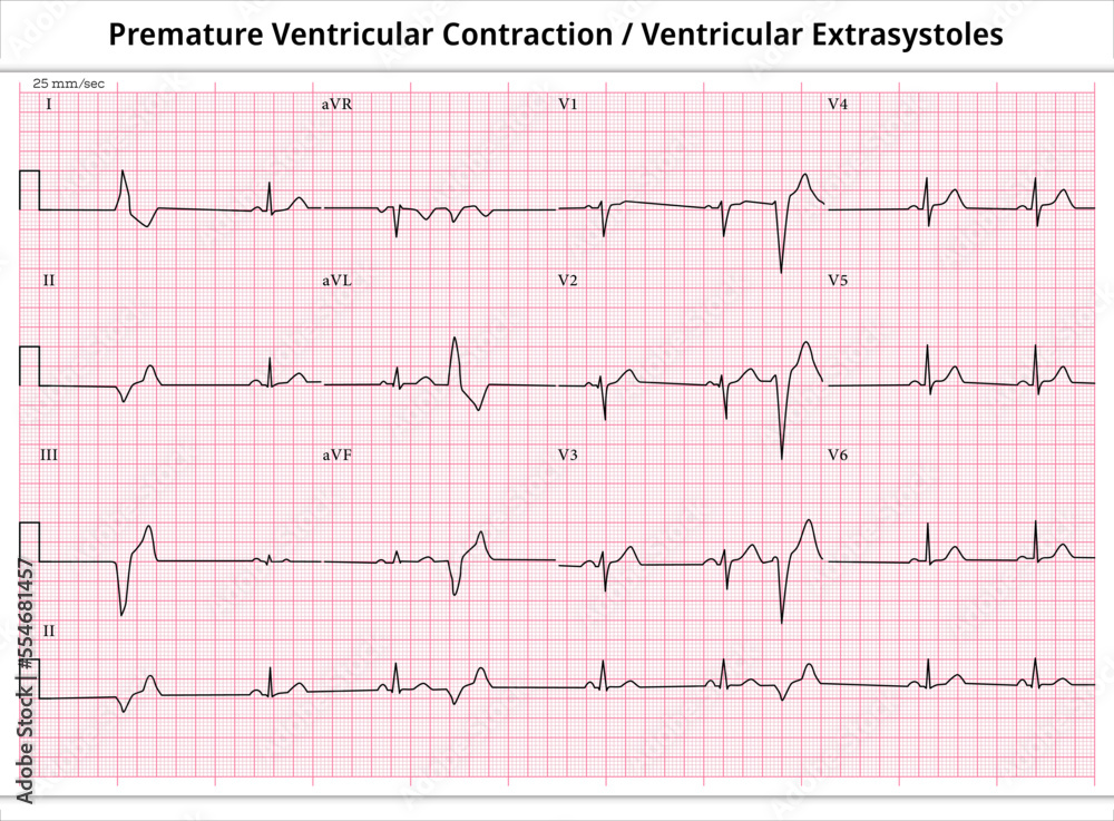 ECG PVC (Premature Ventricular Contractions) - ECG VES (Ventricular ...