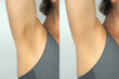 Dark armpit skin caused by allergies and a healthy armpit. Image before and after treatment