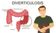 Diverticulosis vector illustration. Medical structure and location. Diverticula infected or inflamed. Intestines. Bowel colon cancer, crohn's disease polyp hernia rectum. Colorectal problems.
