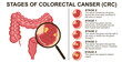Stages of colorectal cancer CRC. Colon cancer. Colorectal oncology tumor. Bowel cancer.	