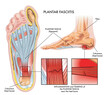 Medical illustration showing section of foot with symptoms of plantar fasciitis with two magnified details of affected points, and annotations.