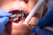© Austockphoto - Lady having dental filling at dentist office