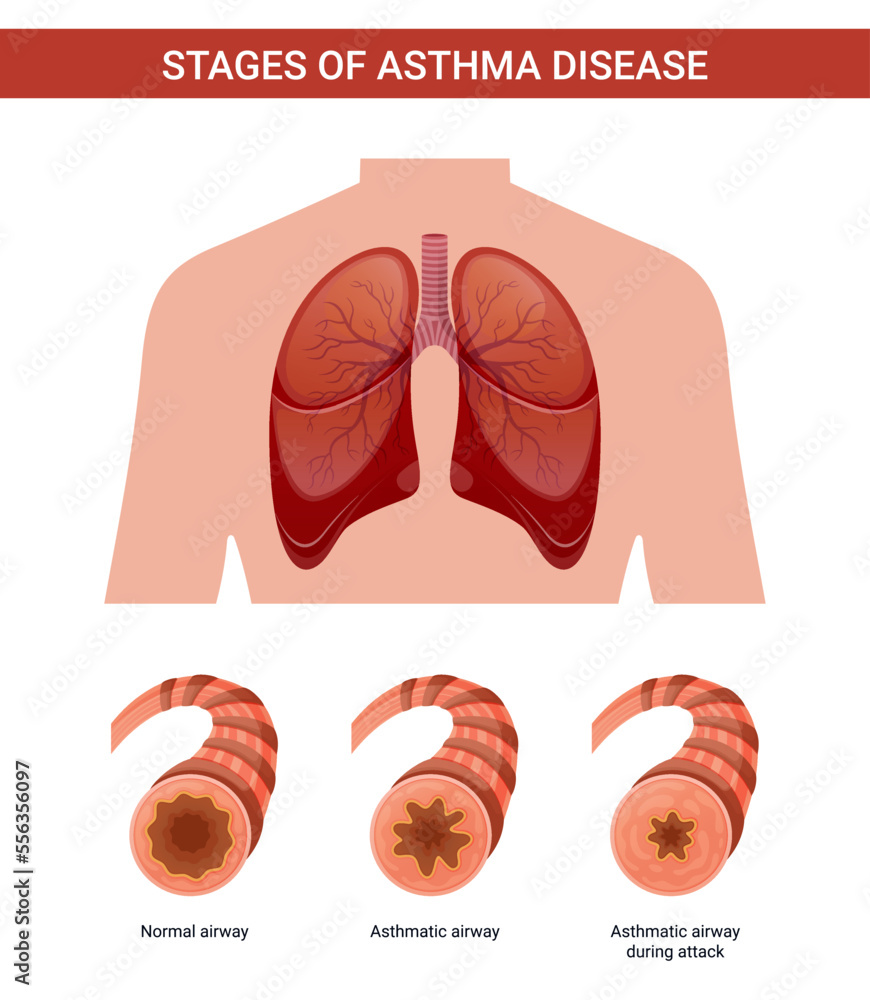 Stages of asthma vector illustration Stock Vector Adobe Stock