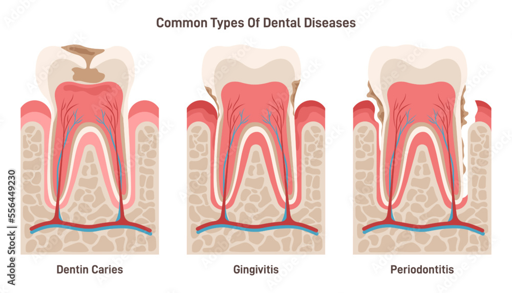 Dental disease set. Dentin caries, gingivitis and periodontitis. Oral ...