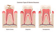 Dental disease set. Dentin caries, gingivitis and periodontitis. Oral cavity