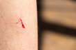 © bankrx - Bruised wound injury with blood bleeding on woman leg background