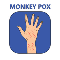 Monkey pox virus icon, cartoon human hand with rash, vector illustration