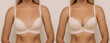 Young tanned blonde woman in bra before and after breast augmentation with silicone implants. The result of a breast lift. Breast size correction on beige background. Plastic surgery concept