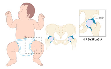 Baby birth and prosthesis damage thighbone joint dislocated broken pain of leg bone treat unstable femur pelvis chronic sport nerve sciatic compression labral tear child hurt thigh closed loose neck