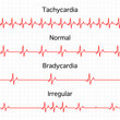 © jirapa - Heart rate graphics. Vector illustration. Electrocardiogram. illustration of medical electrocardiogram - ECG on chart paper. Tachycardia, normal, Bradycardia, Irregular heart beat.