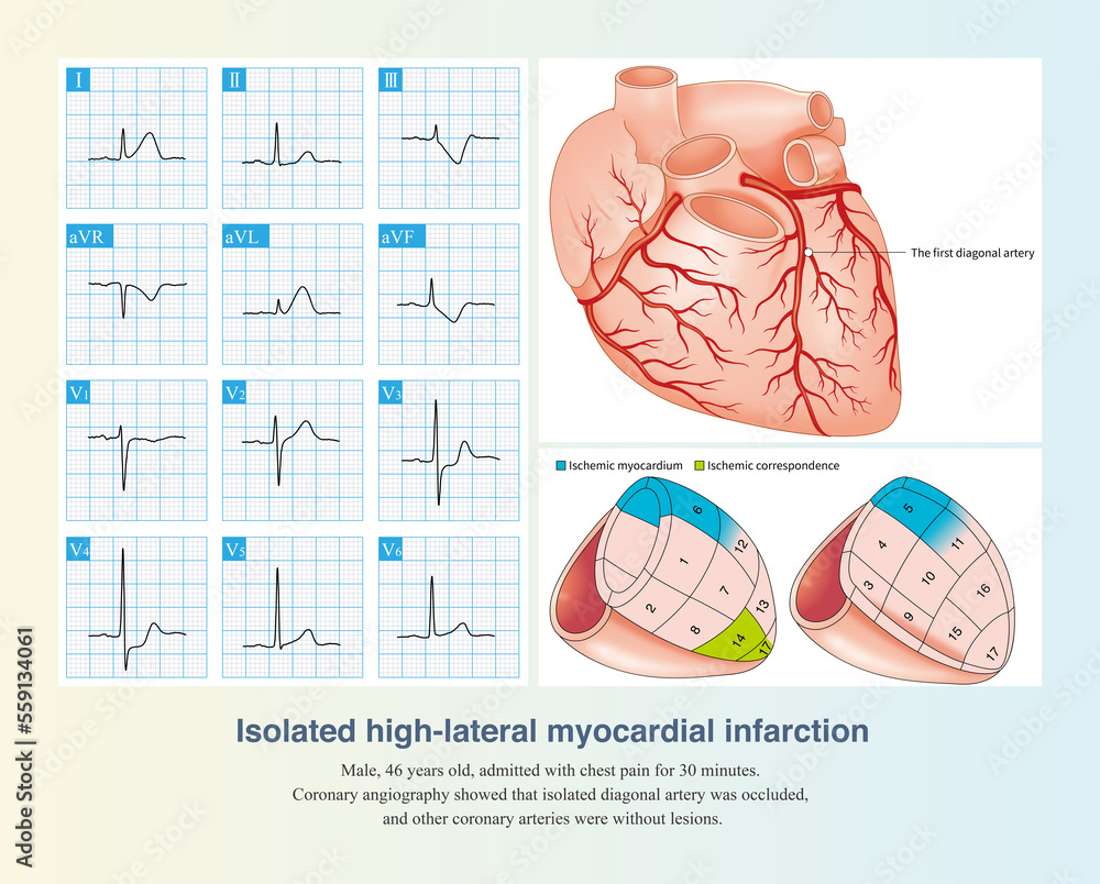Isolated occlusion of diagonal artery can lead to isolated high lateral ...