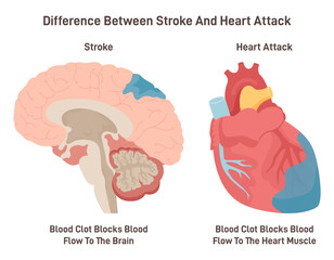 Stroke and heart attack. Plaque develops on the inside of the blood vessel