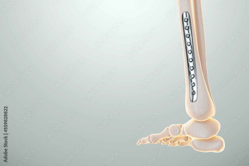 Medical procedure, osteosynthesis operation, surgical repositioning of ...