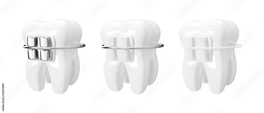 Tooth with dental braces isolated on transparent background 3d ...
