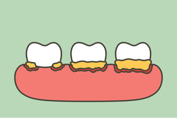 Wall Mural - step of periodontitis or gum disease that is inflamed and has blood - dental cartoon vector flat style
