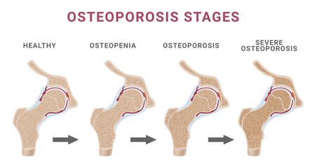 Stages osteoporosis bone spongy structure normal osteopenia severe osteoporosis scheme vector flat