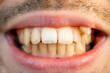 © Ivan - Close up of man's face with crooked teeth before install braces. Teeth need ortodontic treatment.