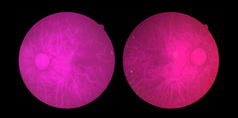 Photo Madical Retina Abnormal isolated on black background.Purple Retina of diabetes , diabates retinopathy.