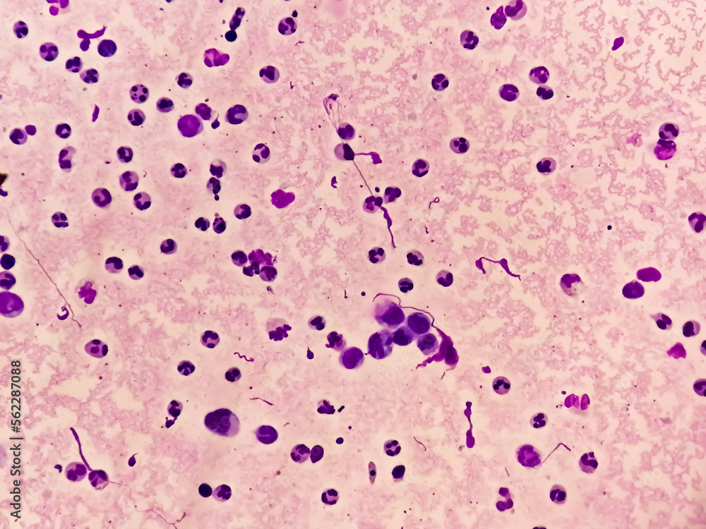 Synovial Fluid Cytology: Plenty WBC, microscopic examination of synovial fluid, to diagnose arthritis, particularly for septic or crystal-induced arthritis.