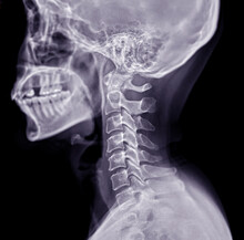 X-ray C-spine Or X-ray Image Of Cervical Spine Lateral View For Diagnostic Intervertebral Disc Herniation And Spondylosis.
