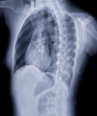 Naklejka na meble Chest x-ray image oblique view  for screening diagnosis TB,tuberculosis and covid-19.