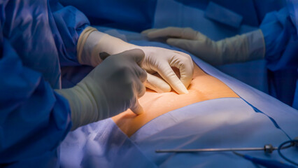 Wall Mural - Close up photo of surgeon 's hand during hold the scalpel and made incision on the patient 's abdomen under the good light from surgical lamp. Picture in blue tone with copy space. Medical concept.